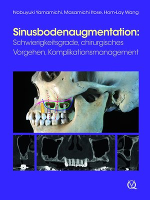 cover image of Sinusbodenaugmentation